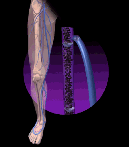 Varicose veins visualization