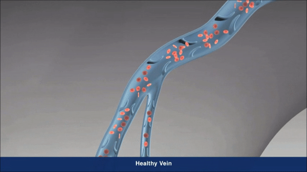 Vein process